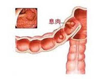 运城众泰肛肠医院:肠息肉危害大,如何预防？