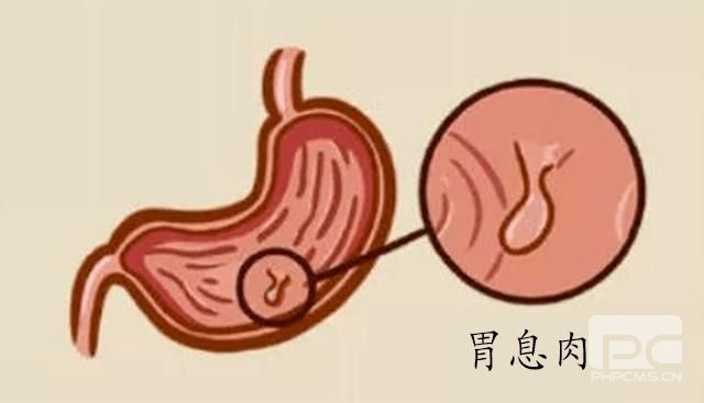 运城众泰肛肠医院：胃息肉怎么治疗？