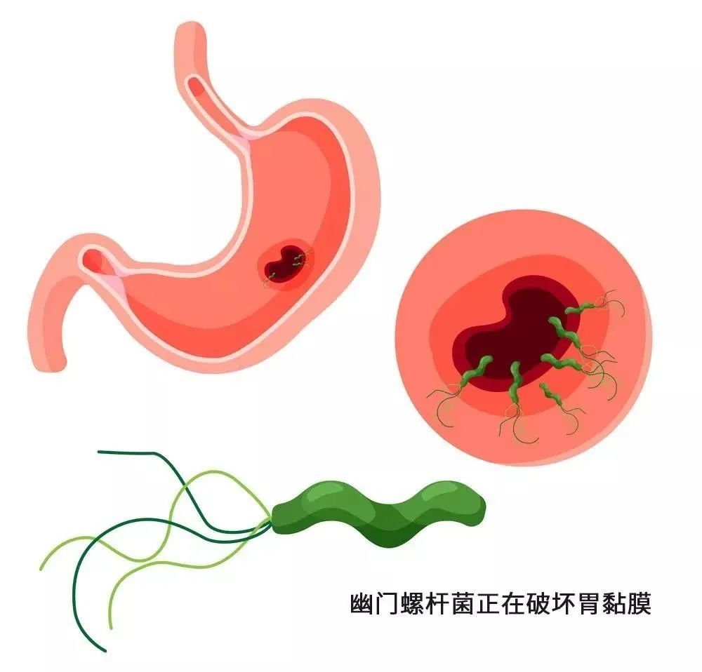 运城众泰肛肠医院：口臭可能是胃癌为你发出的警告