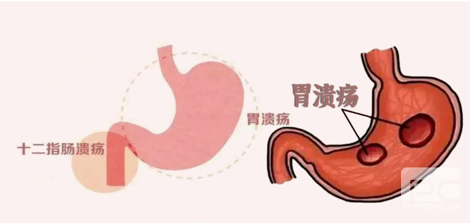 运城众泰肛肠医院：胃溃疡和十二指肠溃疡有什么区别