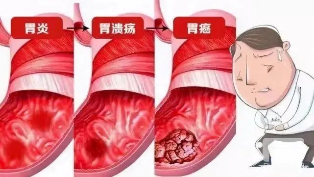 运城众泰肛肠医院：幽门螺杆菌早根除，获益大