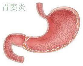 运城众泰肛肠医院：胃窦炎的致病因素有哪些?