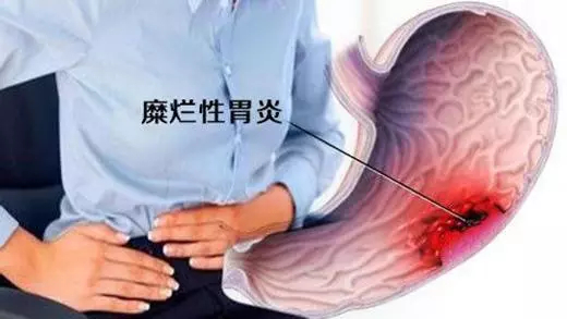 运城众泰肛肠医院：糜烂性胃炎的危害有多大