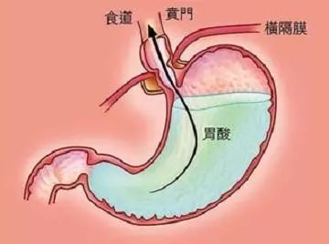 运城众泰肛肠医院：胃酸过度分泌该怎么办？