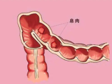 运城众泰肛肠医院：结肠息肉有什么预防措施?