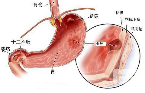 运城众泰肛肠医院：患有十二指溃疡有什么症状？