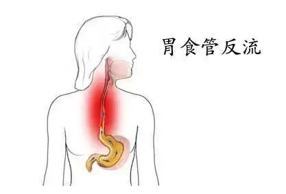 运城众泰肛肠医院：吃完饭，有酸水往上反，这滋味可带劲