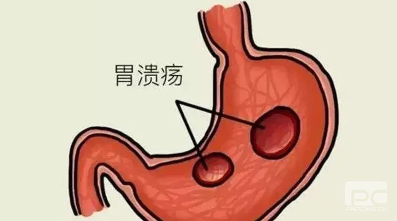 运城众泰肛肠医院：胃溃疡患者如何饮食?