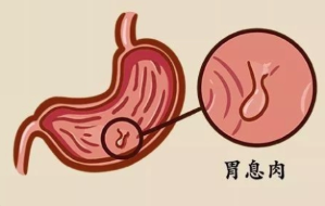 运城众泰肛肠医院：胃部容易长息肉的人群有哪些?