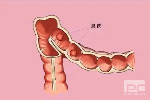 运城众泰肛肠医院：肠息肉隐藏的风险
