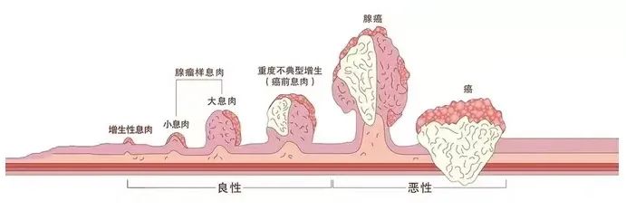 运城众泰肛肠医院：肠息肉发现后该怎么办？