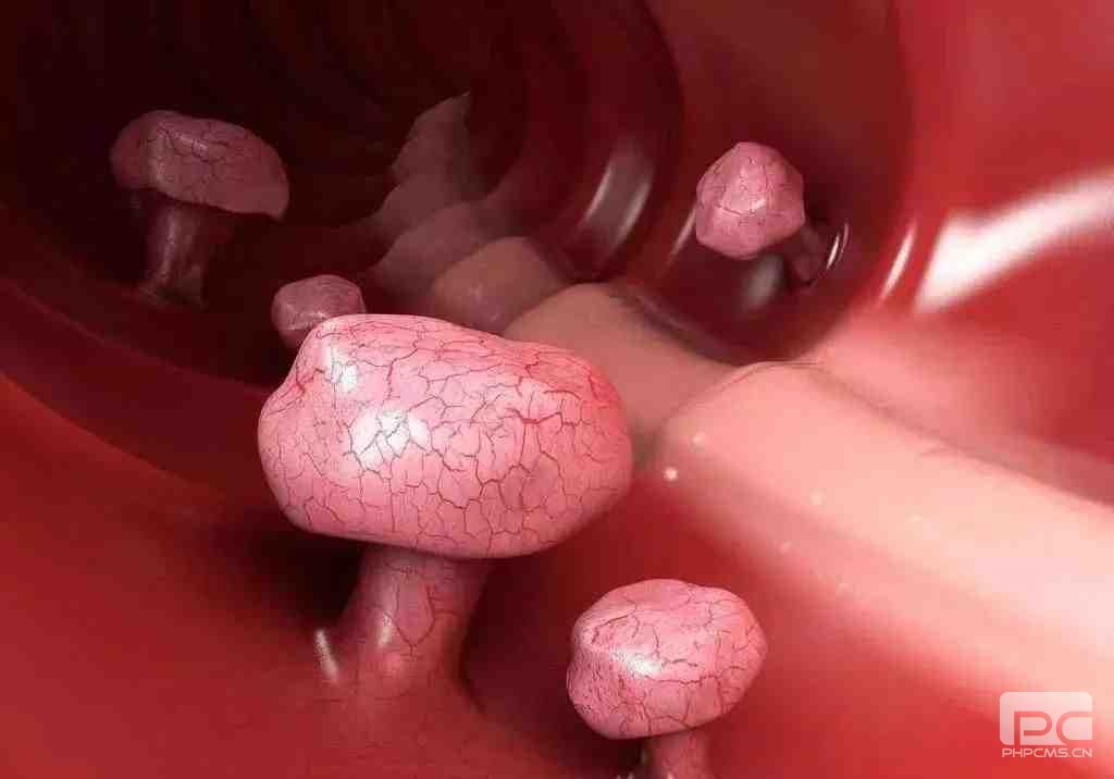 运城众泰肛肠医院：肠息肉有哪些分类？