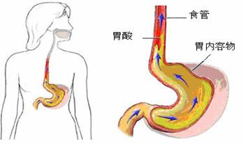 运城众泰肛肠医院：反流性食管炎的症状有哪些?