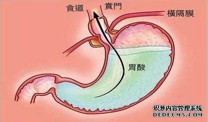 运城众泰肛肠医院：胃酸过多有什么伤害？