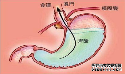运城众泰肛肠医院：胃老是反酸究竟是什么疾病？需要治疗吗？