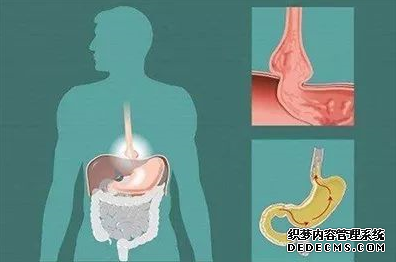 运城众泰肛肠医院：经常反酸、烧心，是这种胃病在“捣乱”