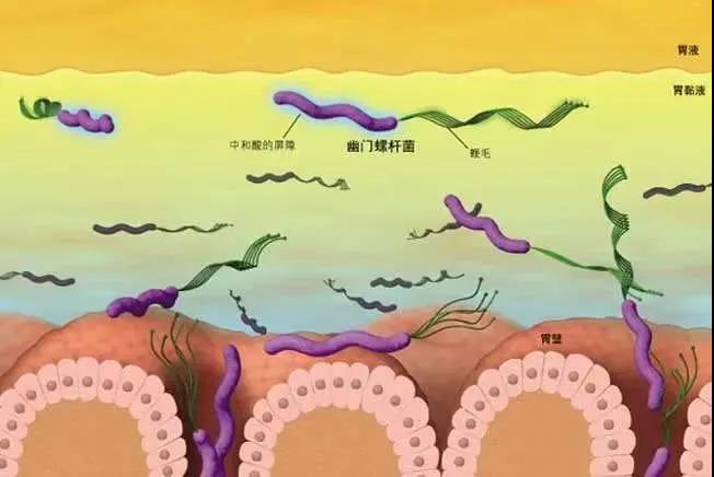 运城众泰肛肠医院：滚蛋吧幽门螺旋杆菌！