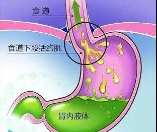 运城众泰肛肠医院：哪些不良习惯会加重“反酸、烧心”发作？
