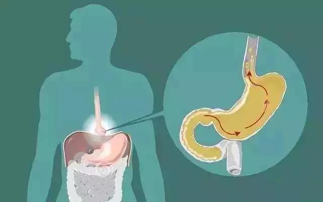 运城众泰肛肠医院：饭后常反酸、烧心？这可不是小毛病！