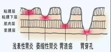 运城众泰肛肠医院：浅表性胃炎，它危害有多大？
