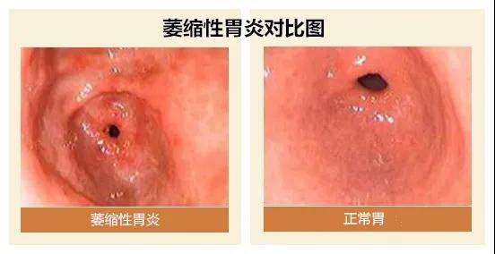 运城众泰肛肠医院：萎缩性胃炎和幽门螺杆菌之间到底什么关系？