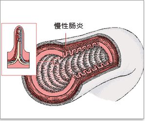 运城众泰肛肠医院：慢性肠炎的症状及危害？