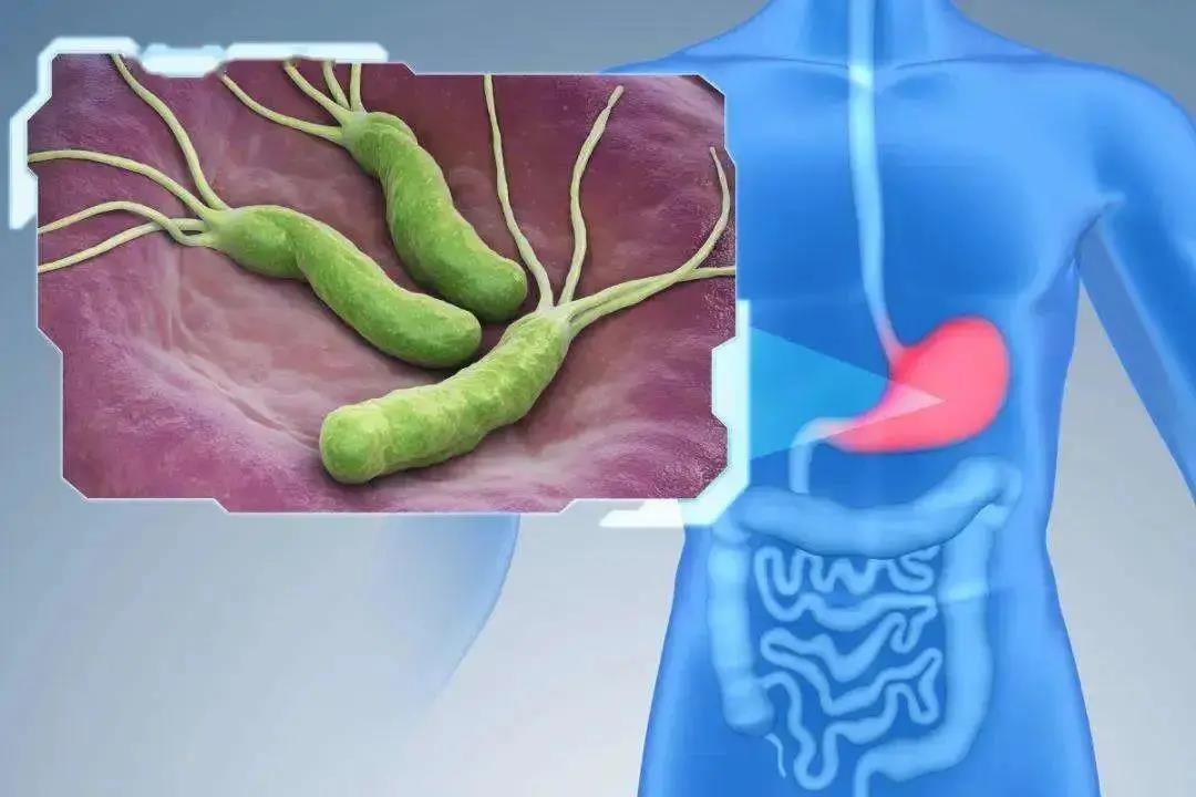 运城众泰肛肠医院：这个细菌是胃癌“帮凶”，全国半数以上人感染！