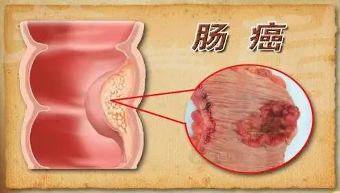 运城众泰肛肠医院：结肠炎的六大危害，八大禁忌需注意！