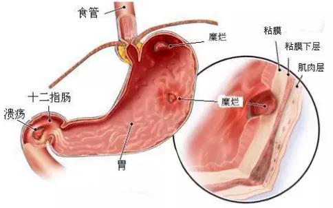 运城众泰肛肠医院：对于糜烂性胃炎，你了解多少
