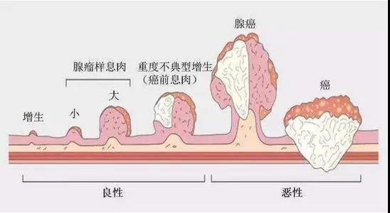 运城众泰肛肠医院：“小息肉”变身“大肠癌”