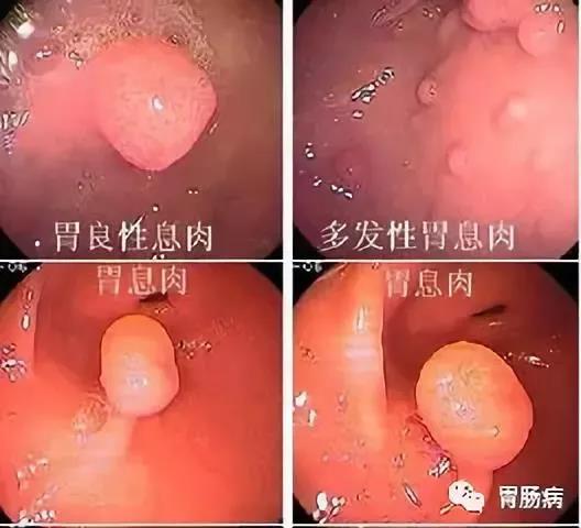 运城众泰肛肠医院：胃息肉会变成胃癌吗？哪些需要切除？7大问题，一文搞定