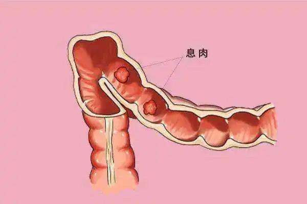 运城众泰肛肠医院：肠息肉高发的几个原因，请当心！