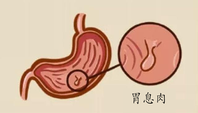 运城众泰肛肠医院：发现胃息肉，这是病变的信号吗？