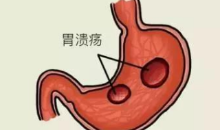 运城众泰肛肠医院：胃溃疡的发病诱因是什么？