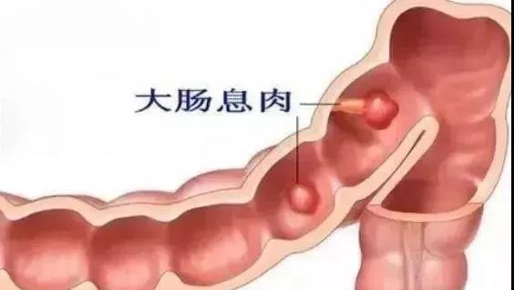 运城众泰肛肠医院：关于肠息肉，你最想知道的9个问题！
