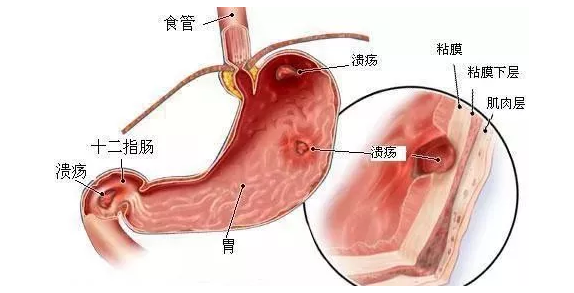 运城众泰肛肠医院：胃炎、胃溃疡的发病原因是什么？