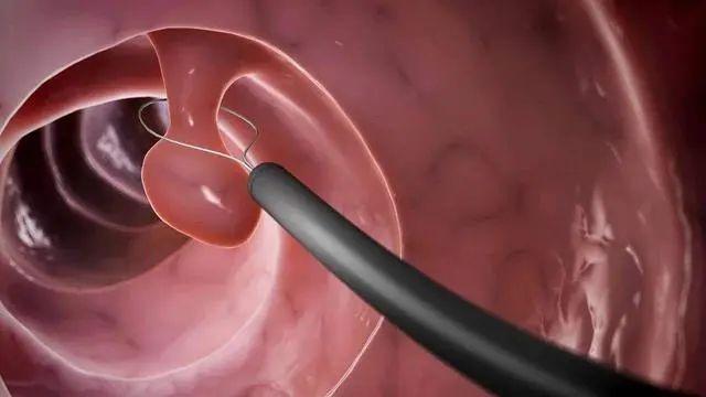 运城众泰肛肠医院：肠道息肉有哪些症状?应该怎么检查?