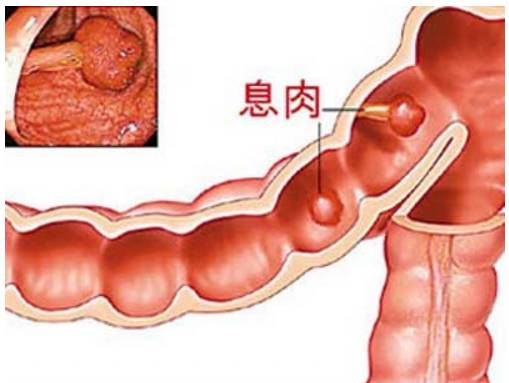 运城众泰肛肠医院：大肠息肉切除以后就可以放心了？定期检查才是关键！