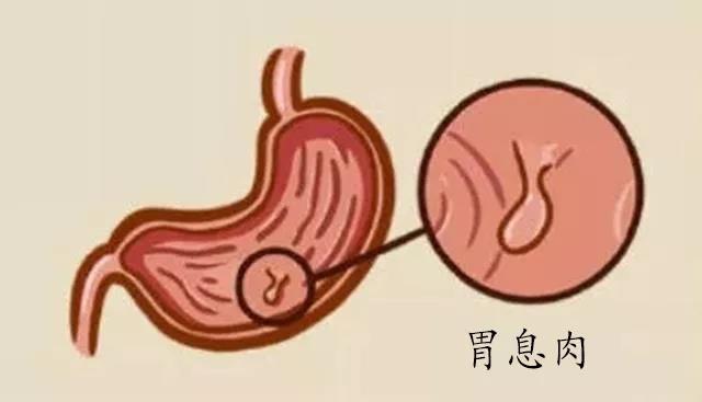 运城众泰肛肠医院：胃里长了一坨肉是怎么回事？