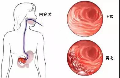 运城众泰肛肠医院：慢性胃炎危害有多大?你不得不知!