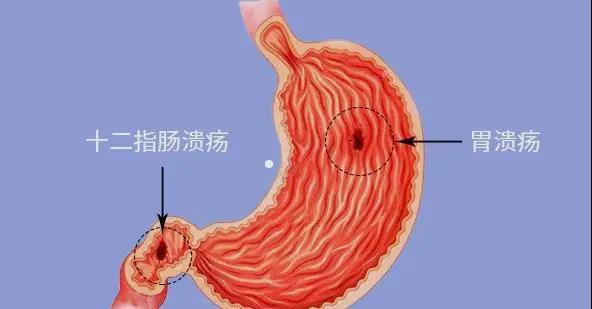 运城众泰肛肠医院：胃溃疡会和口腔溃疡一样，会慢慢自愈吗？