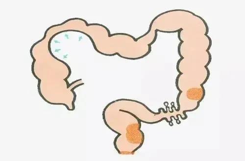 排便不尽，出口梗阻型便秘怎么回事？