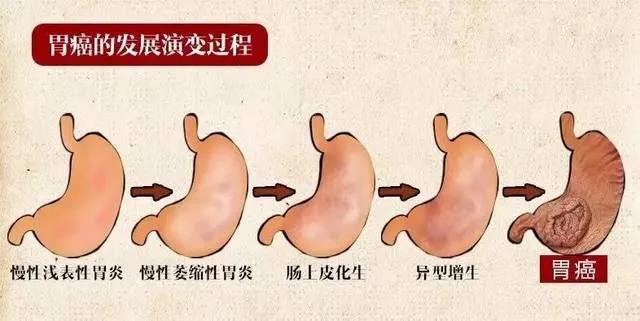 运城众泰肛肠医院：慢性萎缩性胃炎该怎么办？