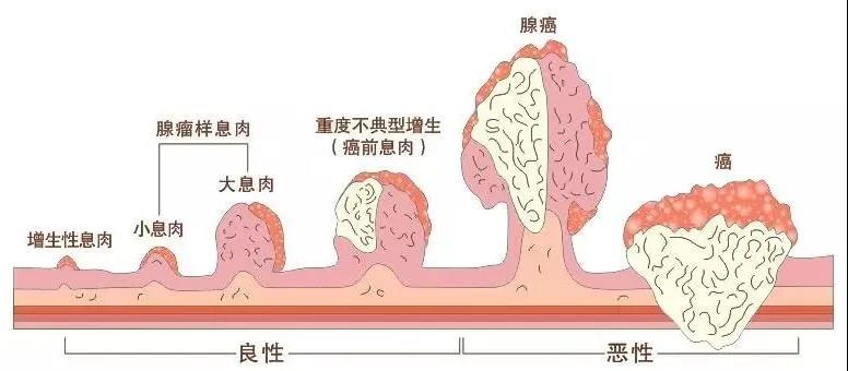 运城众泰肛肠医院：什么样的胃息肉容易癌变？