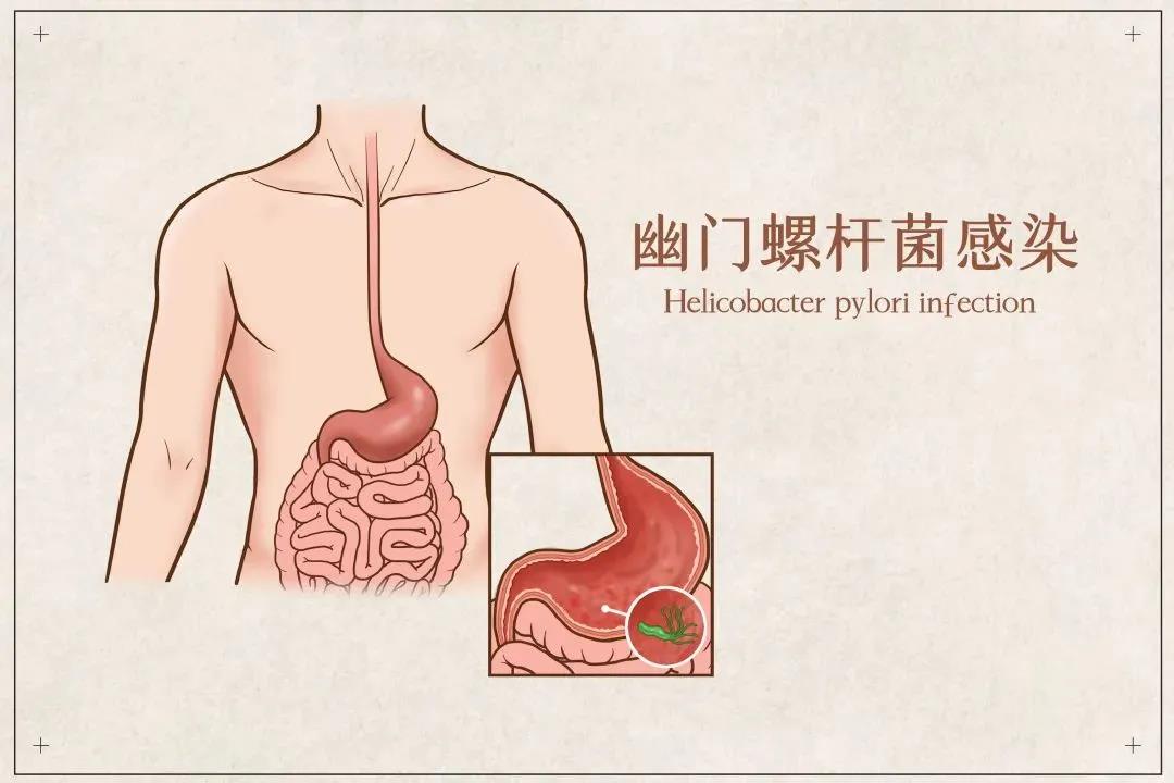 运城众泰肛肠医院：伴“菌”如伴虎，幽门螺杆菌建议根除