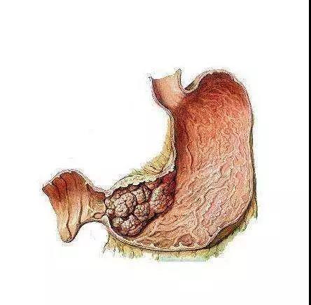 运城众泰肛肠医院：长了一个胃息肉，是胃癌的前兆吗？