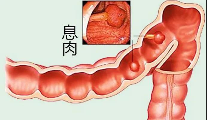 运城众泰肛肠医院：检查出结肠息肉，一定要切除吗？