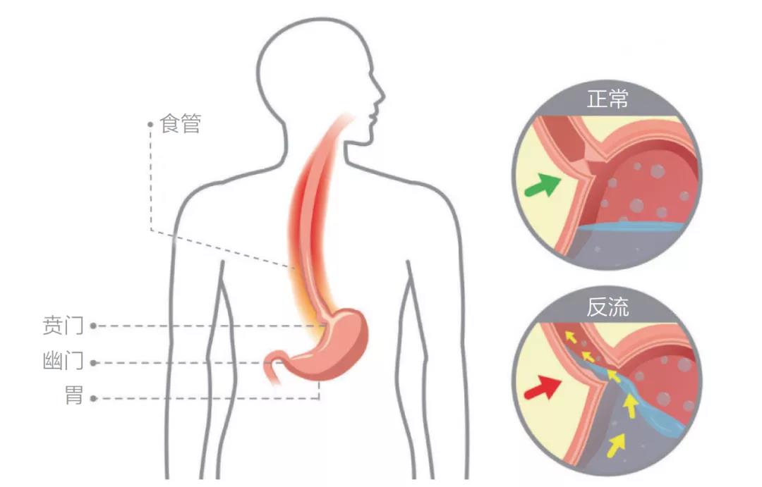 运城众泰肛肠医院：胃反酸、烧心？原来是这道“门”没关紧