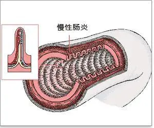 运城众泰肛肠医院：排便不干净是得了慢性肠炎？