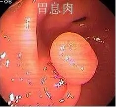 运城众泰肛肠医院：胃息肉到底要不要切除？